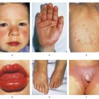 
	Kawasaki disease