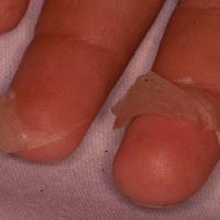 
	Kawasaki disease