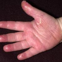 
	Kawasaki disease