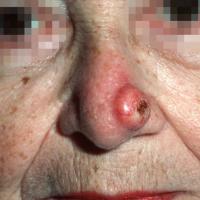 
	Keratoacanthoma on the nose 