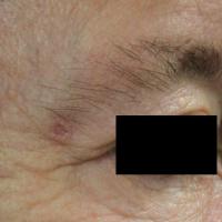 
	Same patient as figure 8

	Six weeks…