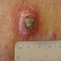 
	Close up of&nbsp;Keratoacanthoma in figure…