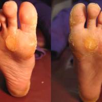 
	Focal and striate keratoderma