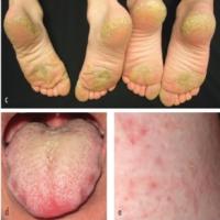 
	Pachyonychia congenita causing a focal…