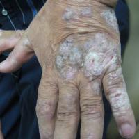 
	Basex's acrokeratosis paraneoplastica…