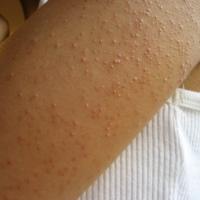 
	Keratosis pilaris 