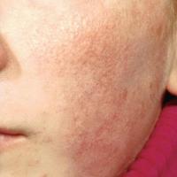 
	Atrophoderma vermiculatam