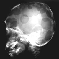 
	LCH affecting the skull 