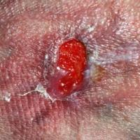 
	Venous leg ulcer

	The ulcer is granulating…