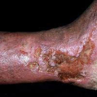 
	Venous leg ulcer

	Copied with kind permission…