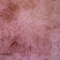 Dermoscopic appearance of previous…