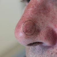 Pigmented actinic keratosisClinically the lesion…