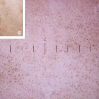 Lichenoid keratosisA benign lesion. A homogenous…