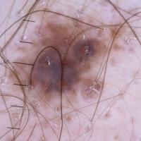 
	Dermoscopic appearance of a lentigo maligna…