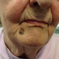 Lentigo maligna melanoma
