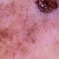Dermoscopic close-up of the lower oval in the…