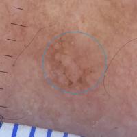 Pigmented actinic keratosisBrown triangular areas…