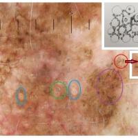 Lentigo maligna - hyperpigmented follicular…