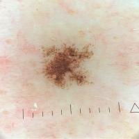 Ink-spot lentigo