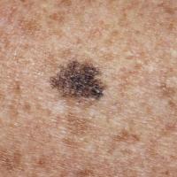 
	Ink-spot lentigo