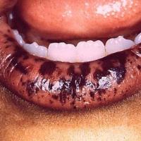 
	Peutz-Jeghers Syndrome