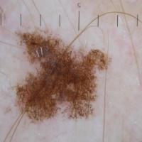 Dermoscopic appearance of previous…
