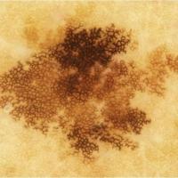 Ink-spot lentigoAlthough the shades of brown are…