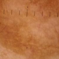 
	Solar lentigo on the face - dermoscopic…