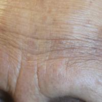
	Frontal fibrosing alopecia - as previous…