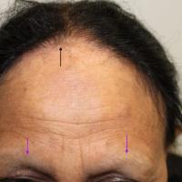 
	Frontal fibrosing alopecia&nbsp;
	
	Frontal…