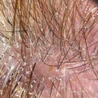 Same patient as previous image - dermoscopic…
