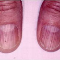 
	Lichen planus causing longitudinal ridging of…