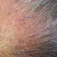 
	Lichen planus affecting the…