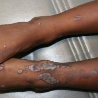 
	Hypertrophic lichen planus