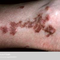 
	Lichen planus, post-inflammatory