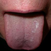 
	Lichen planus on the tongue