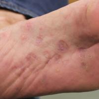 
	Annular lichen planus on the foot