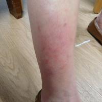 
	Lichen planus

	This very itchy rash was not…
