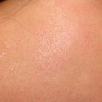 
	Non-genital lichen sclerosus on the upper back…