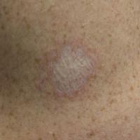 
	Non-genital lichen sclerosus in a male patient