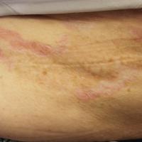 
	Non-genital lichen sclerosus on the upper trunk 