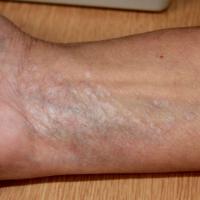 
	Non-genital lichen sclerosus…