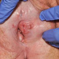 Squamous cell carcinoma secondary to lichen…