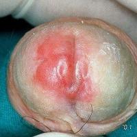 Lichen sclerosus with erythema
