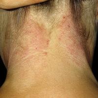 
	Lichen simplex&nbsp;on the posterior neck