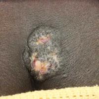 
	Lichen simplex&nbsp;on the lower back

	A…