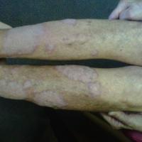 
	Lichen simplex

	A biopsy was taken to rule…