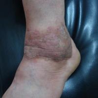 
	Lichen simplex on the ankle