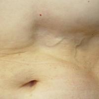 
	Idiopathic lipodystrophy 