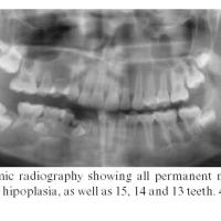 
	Progressive hemifacial atrophy - dental changes